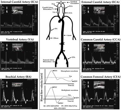 Sex- and Age-Related Physiological Profiles for Brachial, Vertebral, Carotid, and Femoral Arteries Blood Flow Velocity Parameters During Growth and Aging (4–76 Years): Comparison With Clinical Cut-Off Levels